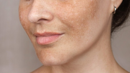 Photoaging-Face: So beugen Sie lichtbedingte Hautalterung vor
