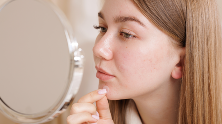 Bye-Bye Blemish: Wie sinnvoll sind Pickel-Patches?
